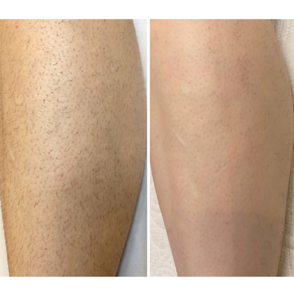 B&A Leg